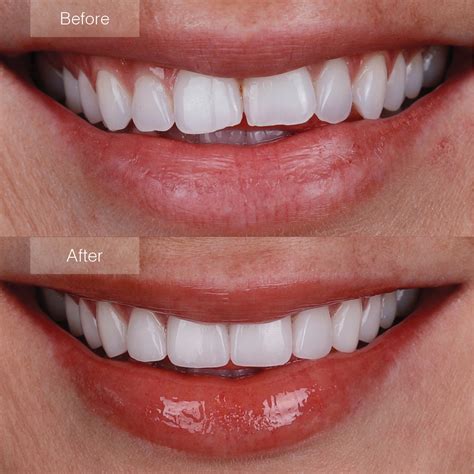 Pin On Hair | Handmade Cosmetic Teeth, Bright White Shade, Comfortable ...