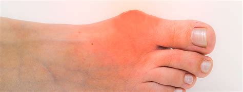 Gout Treatment and Gout Attack Pain Relief -- Northwest Indiana Podiatrist