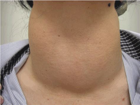 Swollen Neck Thyroid