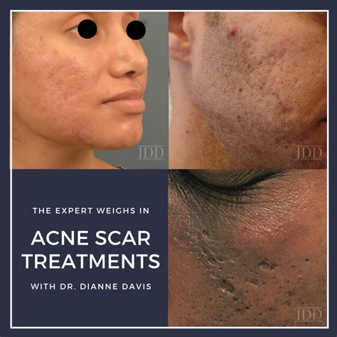 Acne Scar Treatments: The Expert Weighs In - Next Steps in Dermatology