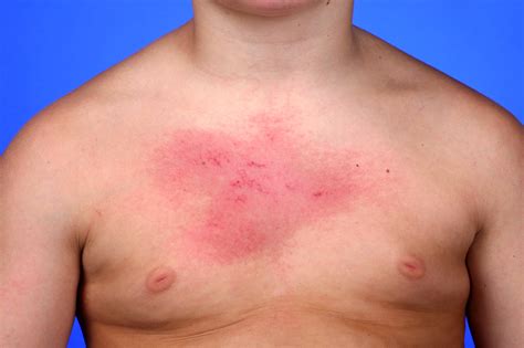 Heliotrope Rash Juvenile Dermatomyositis