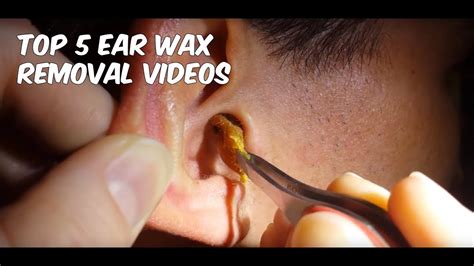 Top 5 Ear Wax Removal Videos | VERY SATISFYING!!! - YouTube