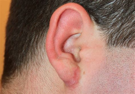 Complex Earlobe Keloid - Treatment with Cryotherapy