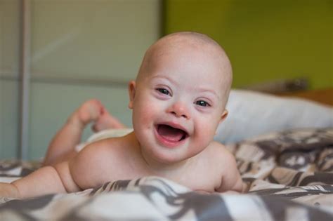 Survival outlook improving for babies with Down syndrome | Latest news ...