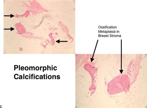 A: Pleomorphic/Heterogeneous | Radiology Key