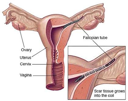 Essure Device