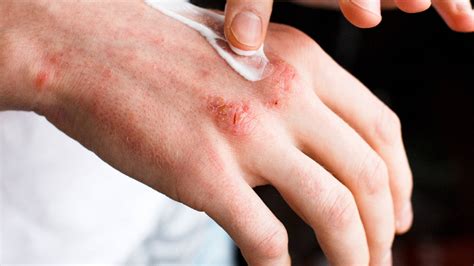 Psoriasis and mental health: Know how this skin disease is linked to ...