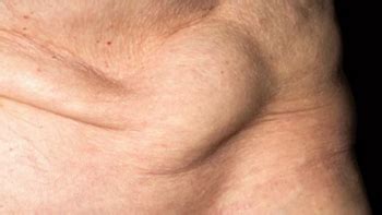 What is Inguinal Hernia? Causes, Surgery, Recovery