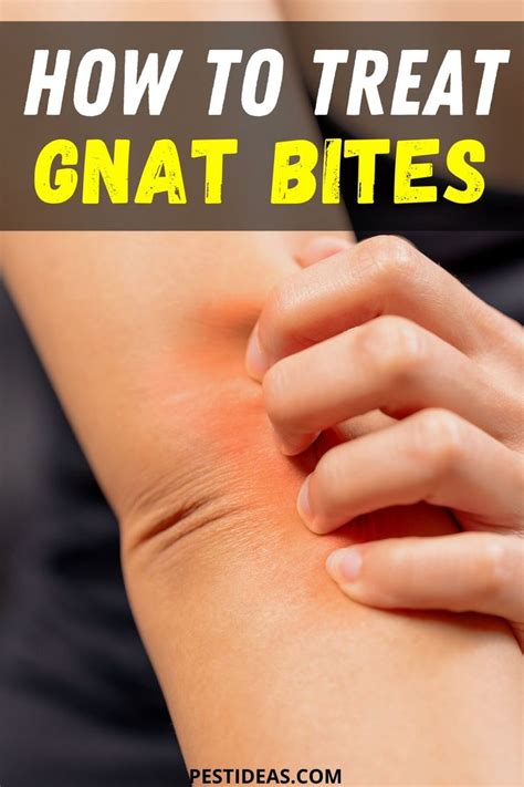 How to Treat Gnat Bites in 2020 | Gnat bites, How to get rid of gnats ...