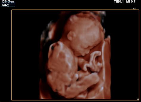 20 week 3d ultrasound face - linksfiln