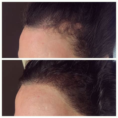 Hairline tattoo by Caroline Wortham at Microbeauty.US location in ...