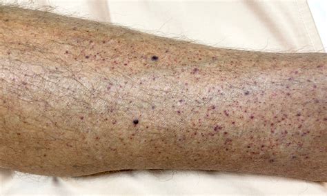 Petechiae - Symptoms, Causes, Treatment and Prevention-Ask Apollo Blog