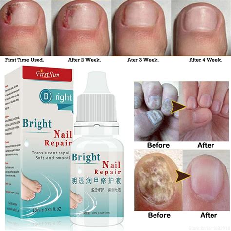 10ml Fungus Treatment Cream Onychomycosis Paronychia Anti Fungal ...