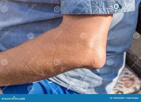 Inflamed Bursa on the Elbow of a Man Stock Image - Image of retention ...