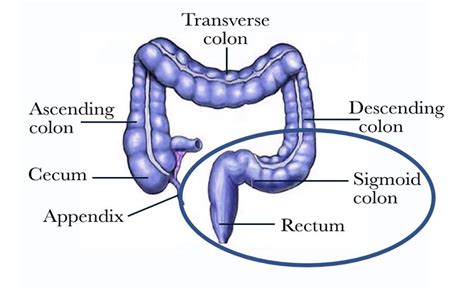 Flexible sigmoidoscopy - Maher A. Abbas, MD | Proctology, Colonoscopy