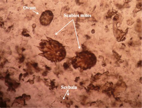 Scabies Eggs Under Microscope