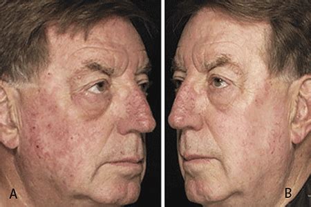 Actinic Keratosis: Diagnosis and treatment | South Nassau Dermatology