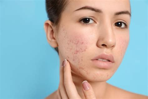 Skincare Routine FAQs | When should I see a dermatologist for acne?