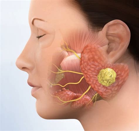 After Parotid Gland Surgery - ENT Clinic