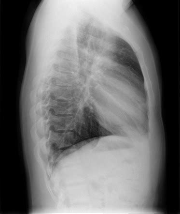 Chest (lateral view) | Radiology Reference Article | Radiopaedia.org