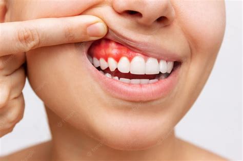 Bleeding Gums: Causes and Home Remedies - Express Dentist