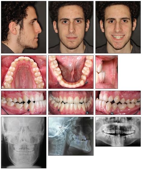 Tandem Skeletal Expander and MAPA Protocol for Palatal Expansion in ...