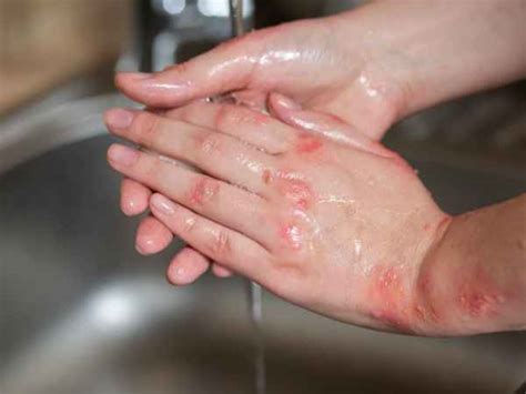 Eczema Scars: What All You Should Know? - TV Health