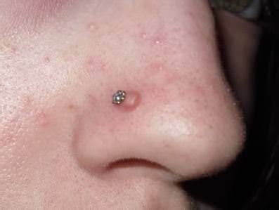 Infected Nose Piercings: Symptoms and Treatment - AuthorityTattoo