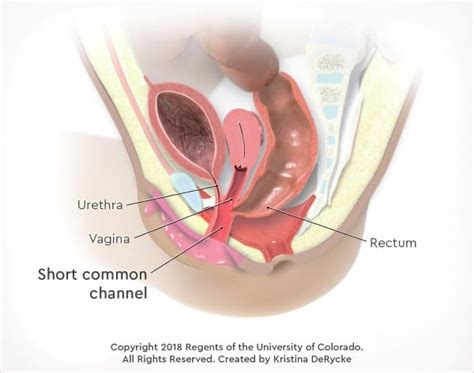 Cloacal Malformations | Children's Hospital Colorado