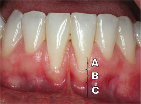 Gingival Anatomy - Anatomical Charts & Posters