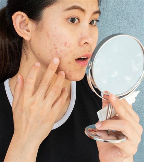 Nodular Acne: Causes, Treatment Options, & Home Remedies