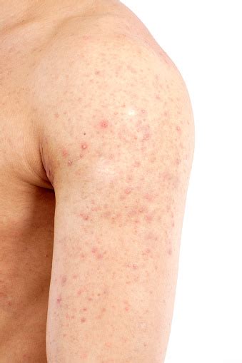 Red Acne On A Male Shoulder And Upper Arm Stockfoto en meer beelden van ...