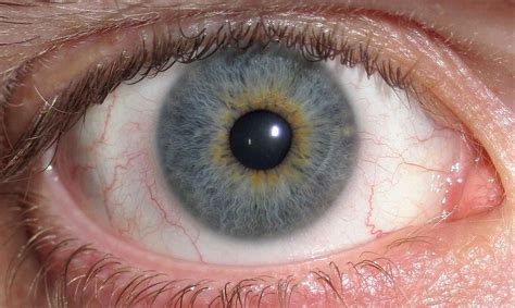 Central Heterochromia: A Rare Eye Condition