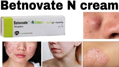 Betnovate n Skin care Cream: How to use, Benefits & Side effects - YouTube