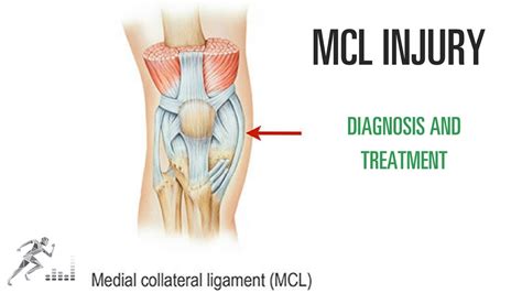 MCL tear of the knee: Injury, diagnosis, treatment - YouTube