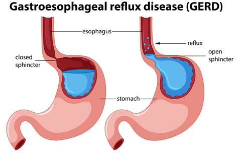 Gastroesophageal Reflux Disease (GERD) - SONOSIF - by SIFSOF, California