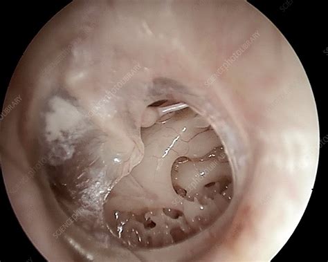 Ruptured Eardrum Otoscope