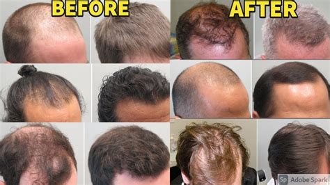 Teuer verdünnen Speziell minoxidil before after Hand voll Oberer, höher ...