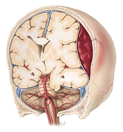 Epidural Hematoma | The Neurosurgical Atlas