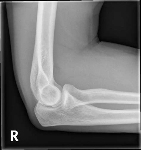 normal-elbow-lateral - ALiEM