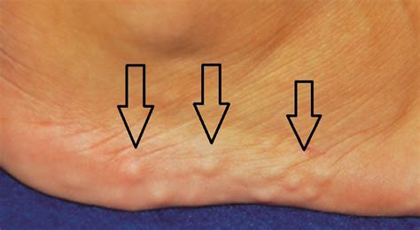 Piezogenic Pedal Papules - Ankle, Foot and Orthotic Centre