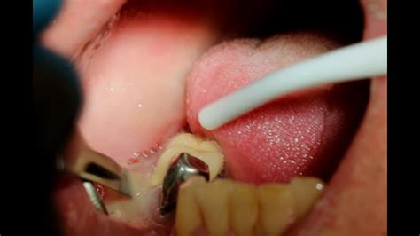 Explosive Drainage of Pus from a Dental Abscess - Dental Clinic