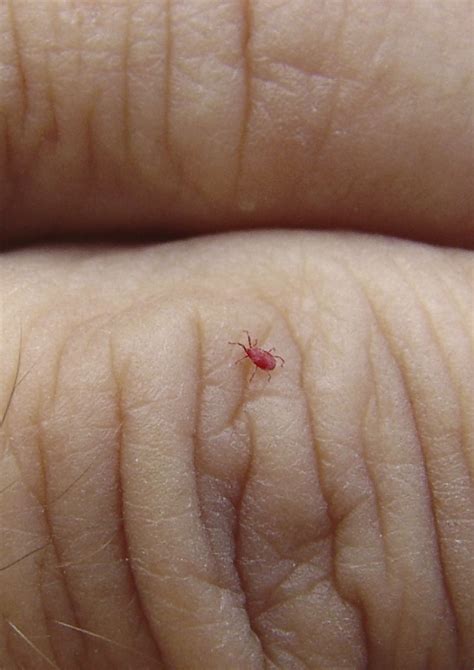 Here’s how you can figure out what these 9 common bug bites are this ...