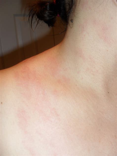 Skin rash celiac disease – Artofit