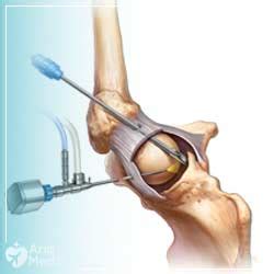 Arthroscopic knee debridement in Iran | best cost | AriaMedTour