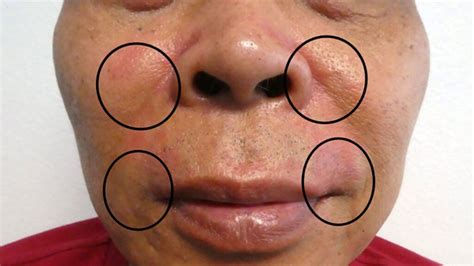 Perioral Dermatitis Causes