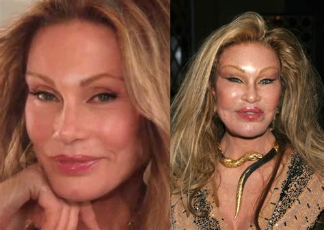 Most Expensive Plastic Surgery In Hollywood - Plastic Industry In The World