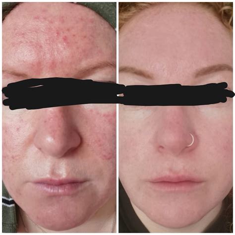 Progress pic, approx six weeks into Rozex (Metronidazole) : r/Rosacea