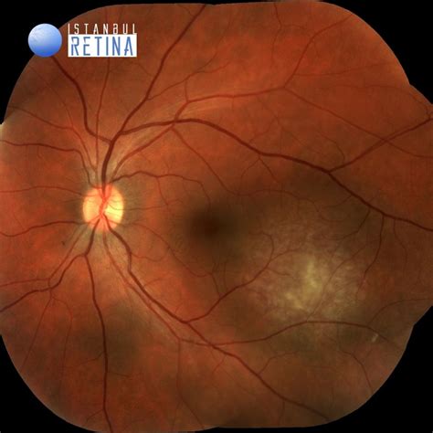 48. Circumscribed Choroidal Hemangioma | OCT Club