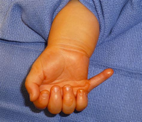 Extra Digits | Congenital Hand and Arm Differences | Washington ...